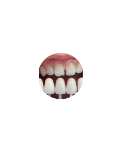 Veneers